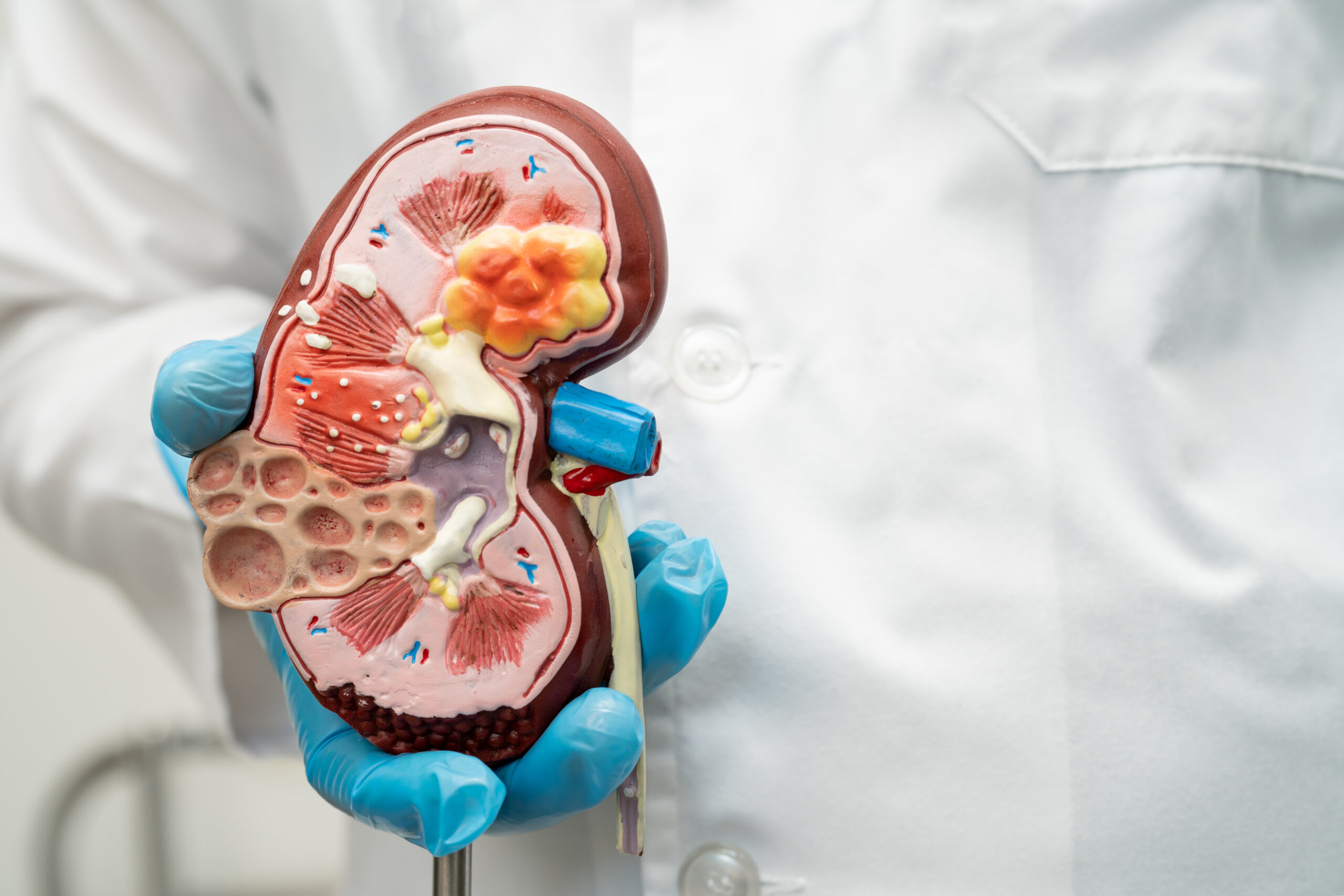Kidney disease, Chronic kidney disease ckd, Doctor hold human mo
