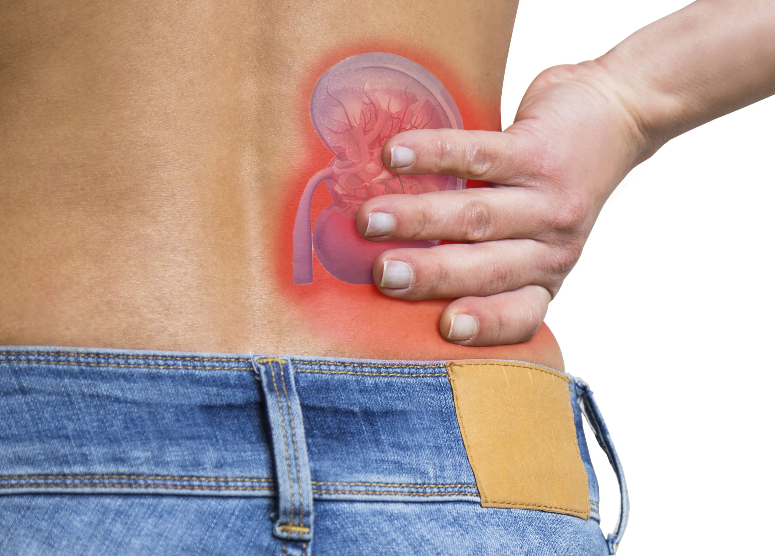 Image kidney cancer advanced stage
