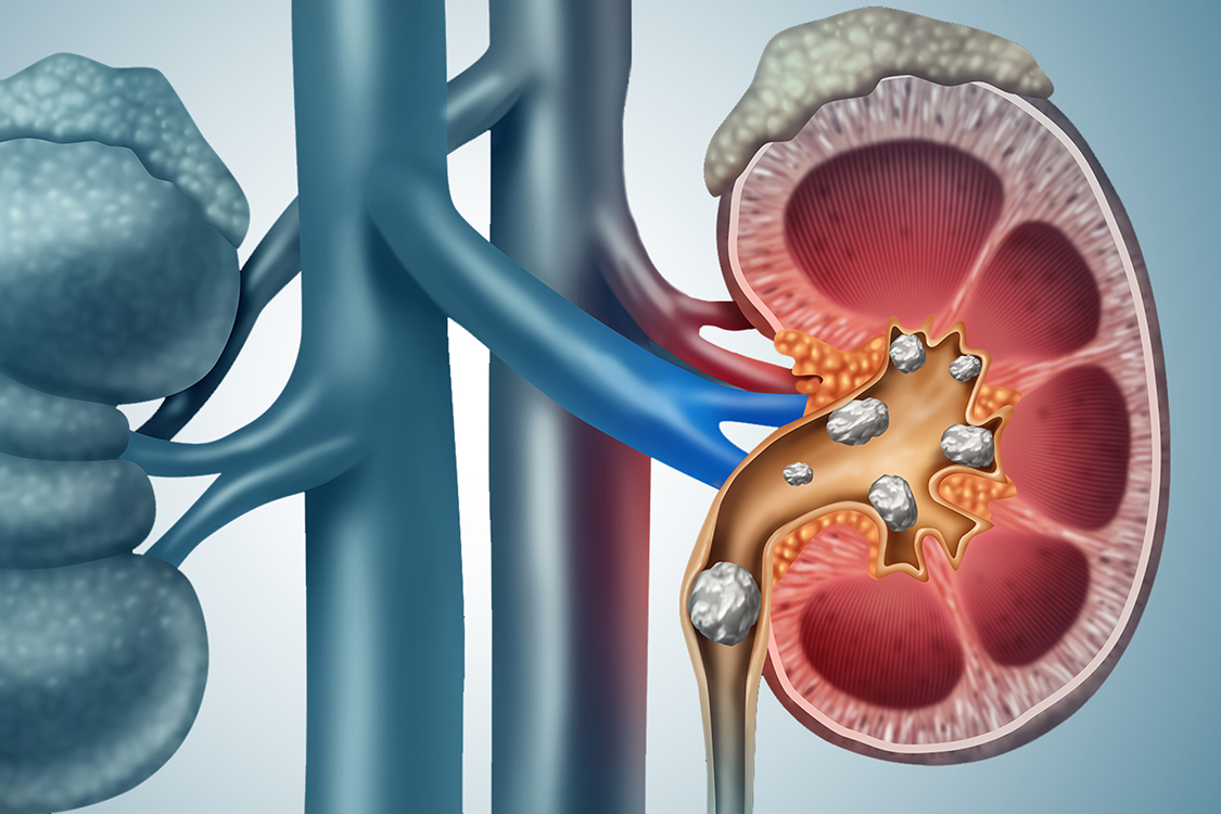 Kidney Stones