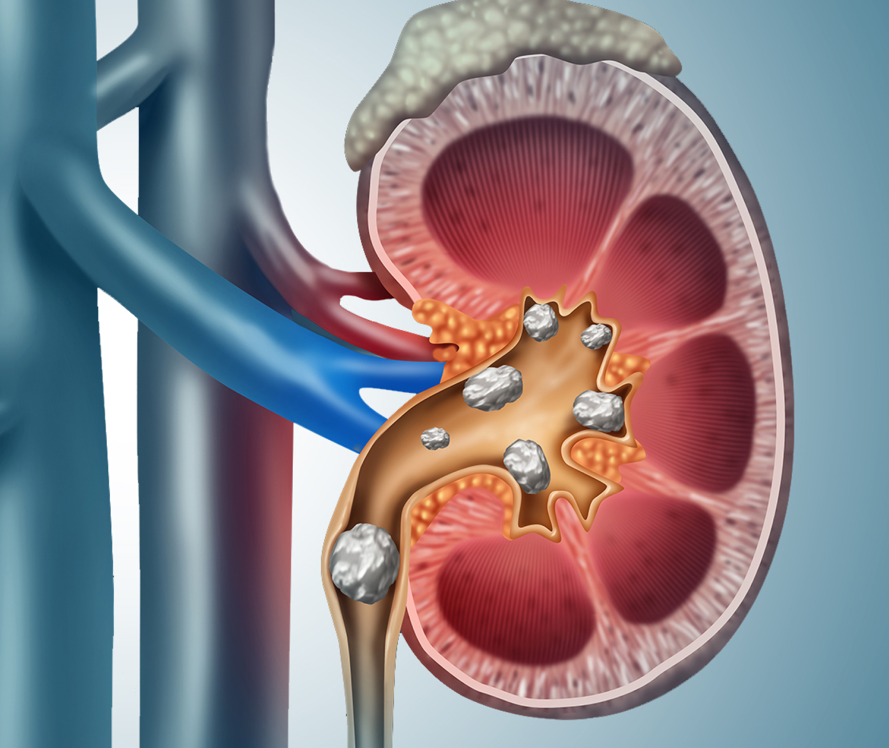 kidney stones